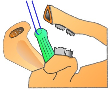 Arthroscopic Repair Chronic ACJ Injury