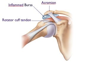 Arthroscopic Subacromial Decompression