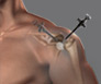 Arthroscopic - Shoulder & Elbow Clinic