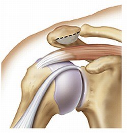 Causes of Impingement