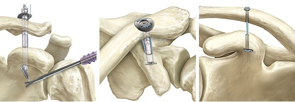 Arthroscopic Repair Acute ACJ Injury Midlands ACJ Dislocation Birmingham